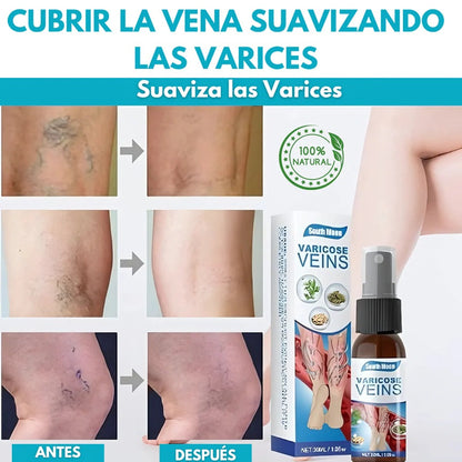 Spray Anti-Varices 100% Natural,DILE ADIOS AL DOLOR EN TUS PIERNAS😊 LLEVA 2X1