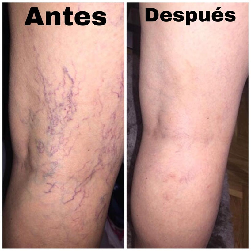 Spray Anti-Varices 100% Natural,DILE ADIOS AL DOLOR EN TUS PIERNAS😊 LLEVA 2X1